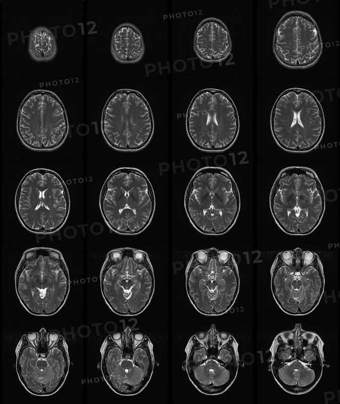 MRT scan