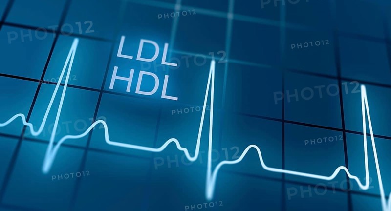 ECG