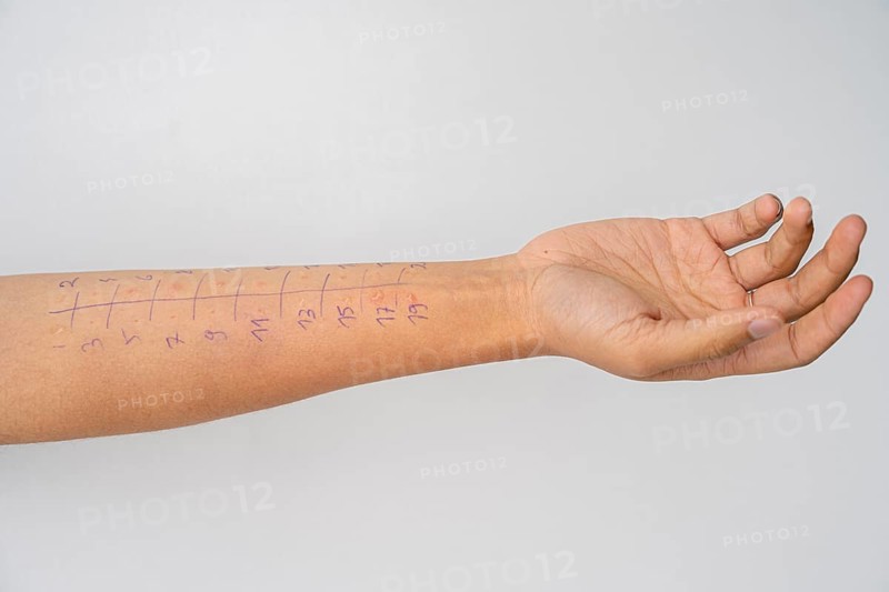 Allergy test