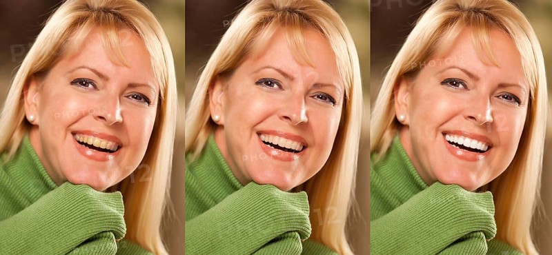 Smiling female showing progressive teeth whitening and bleaching