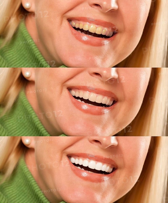 Smiling female showing progressive teeth whitening and bleaching
