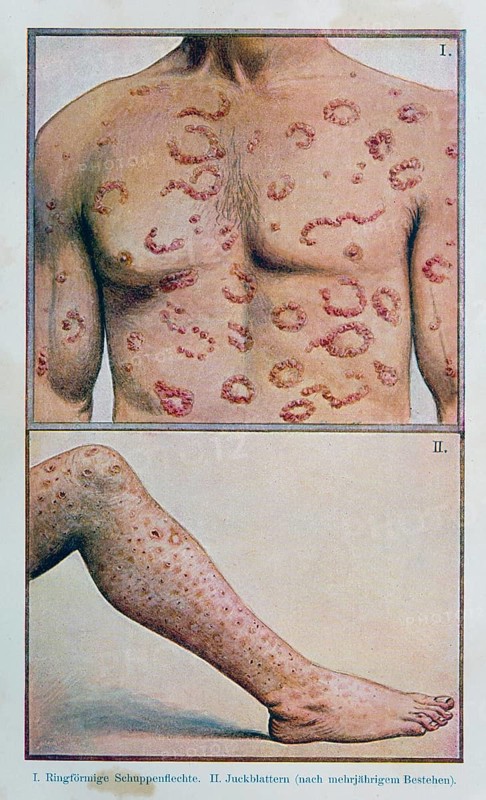 Annular psoriasis and itching patches