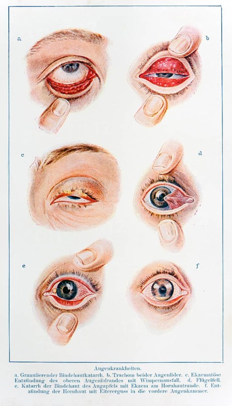 Various eye diseases