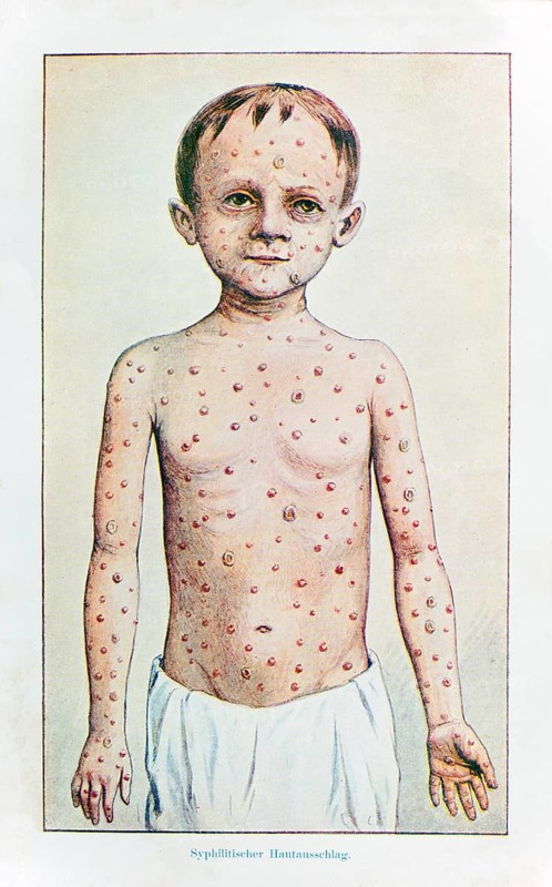 Skin rashes in syphilis