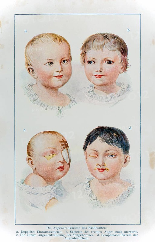 The eye diseases in children