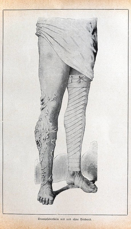Varicose veins (varicosis) with and without bandages