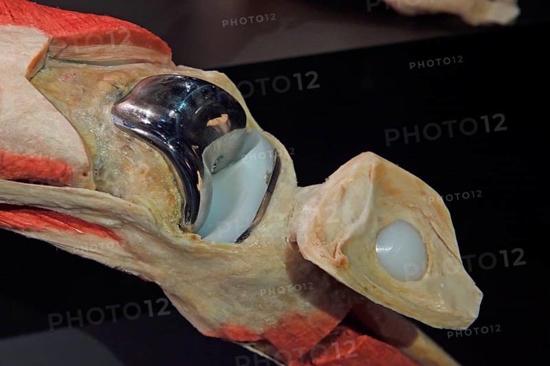 Artificial knee joint