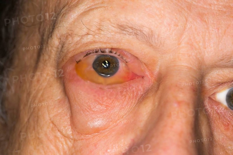 Infectious conjunctivitis