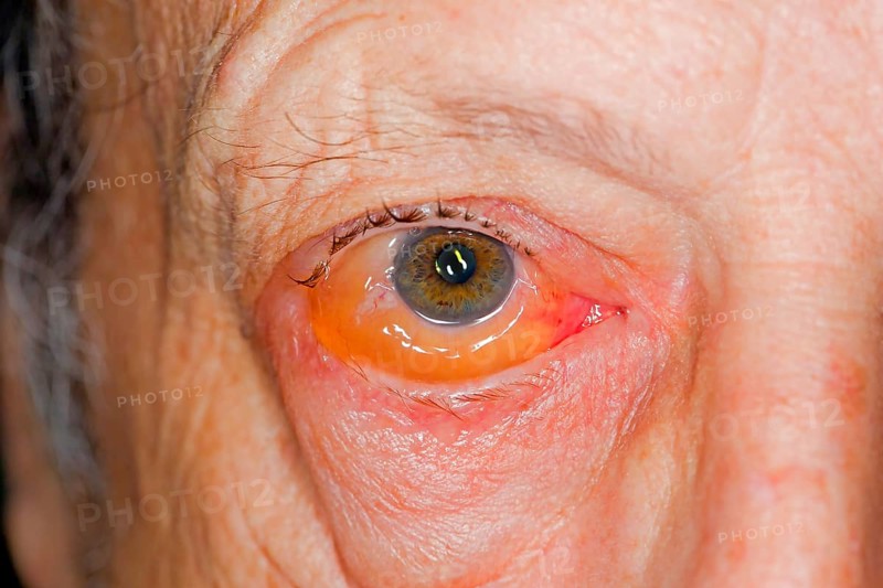 Infectious conjunctivitis