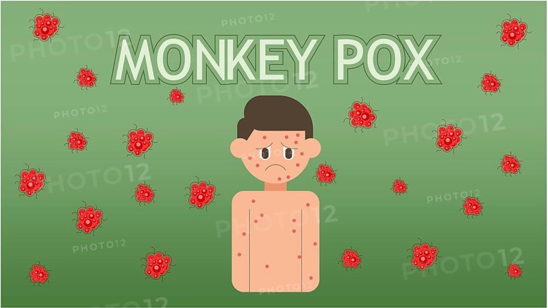 Monkeypox concept