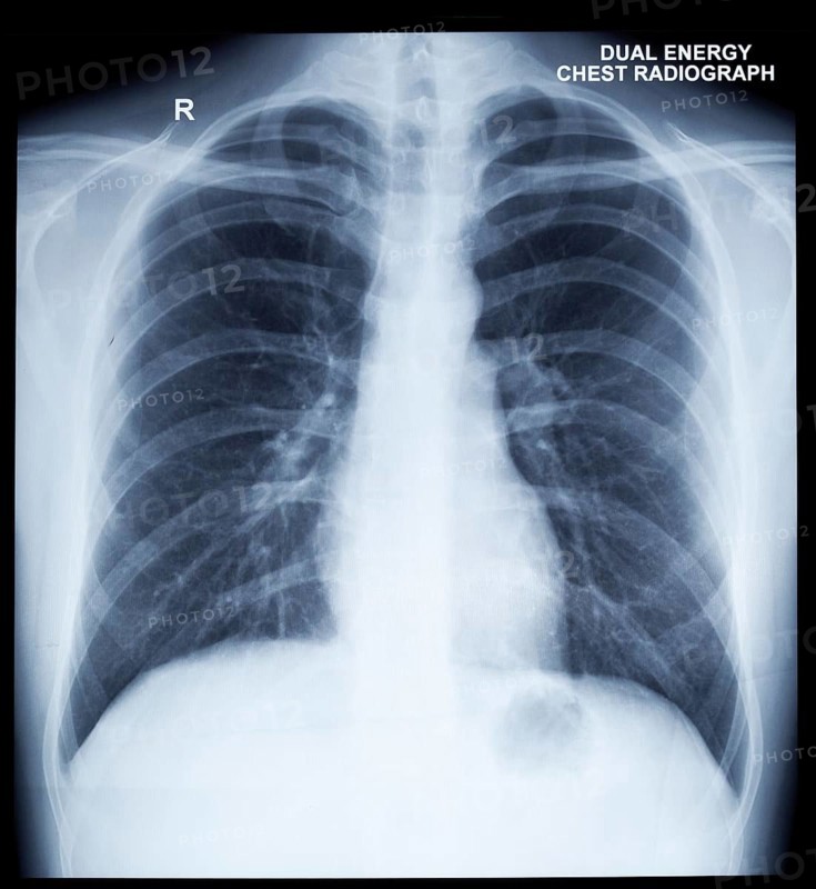 X-Ray Image Of Human Healthy Chest