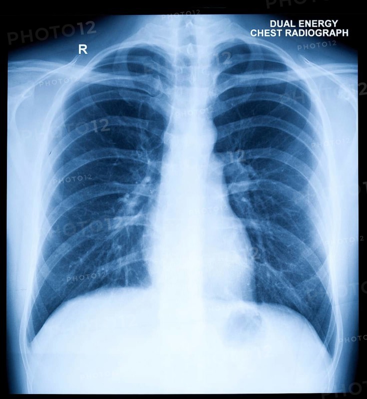 X-Ray Image Of Human Healthy Chest