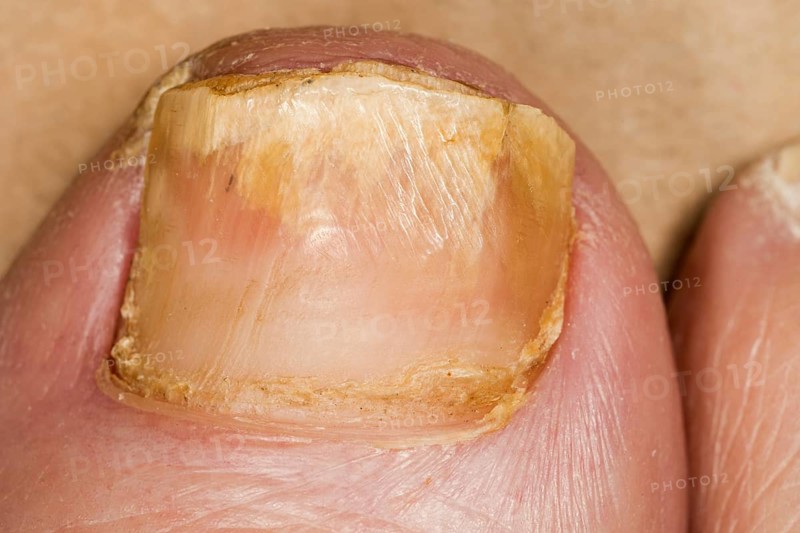 Nail fungus