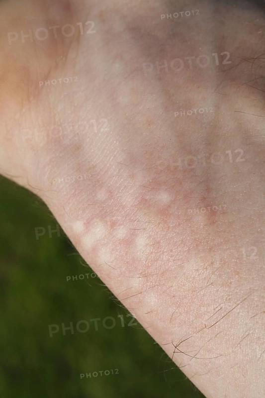 Stinging nettle