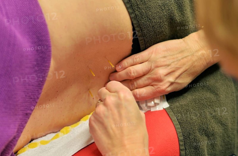 In the family doctor's consultation. Acupuncture