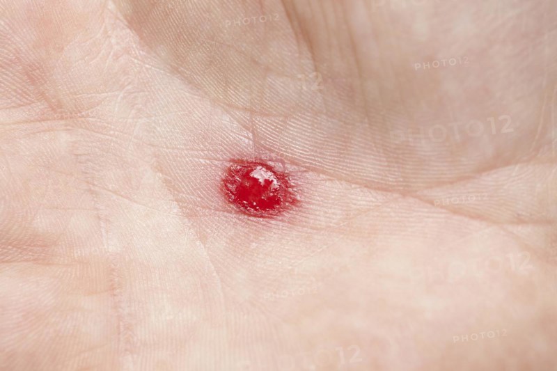 Blood on a palm