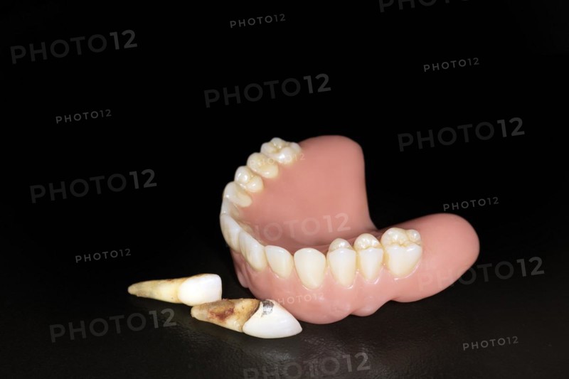 Denture upper jaw made of plastic with pulled teeth