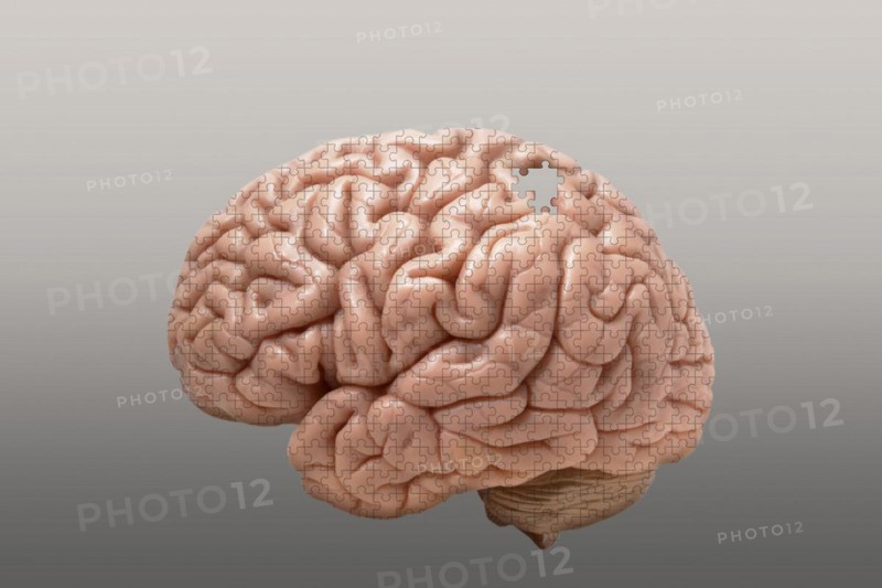 Alzheimers disease