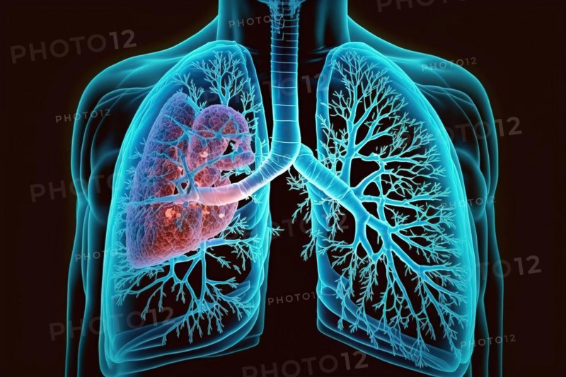 Schematic representation of a lung with bronchi and bronchioles as well as expression of a metastatic lung carcinoma