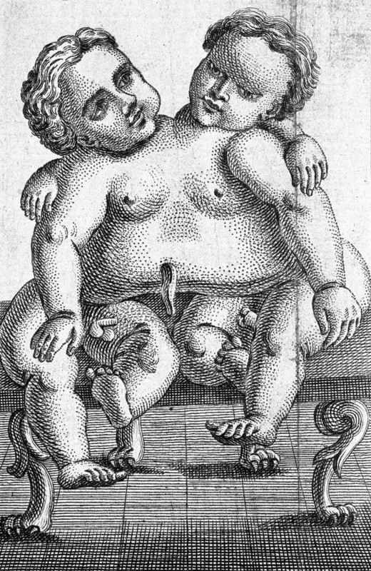 Siamese twins born in Palermo in 1755