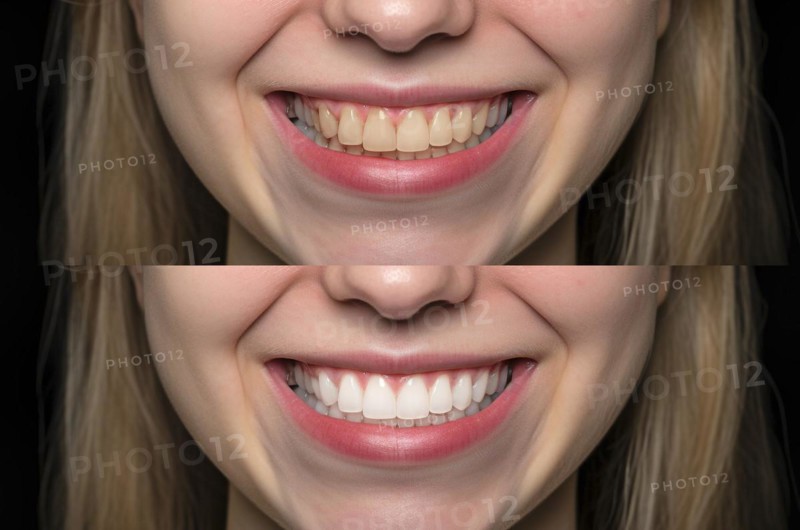 Young adult girl showing her beautiful before and after teeth whitening smile