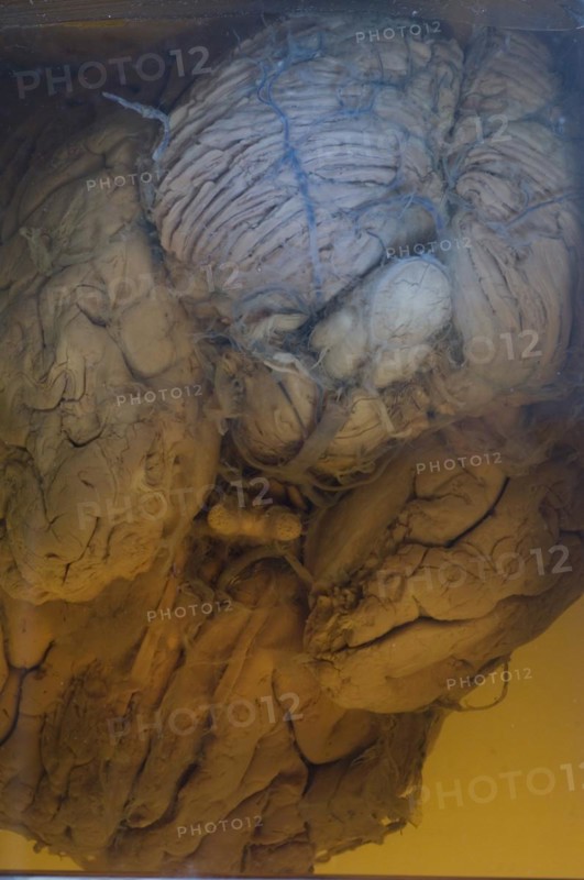 Human brain embalmed in a glass jar