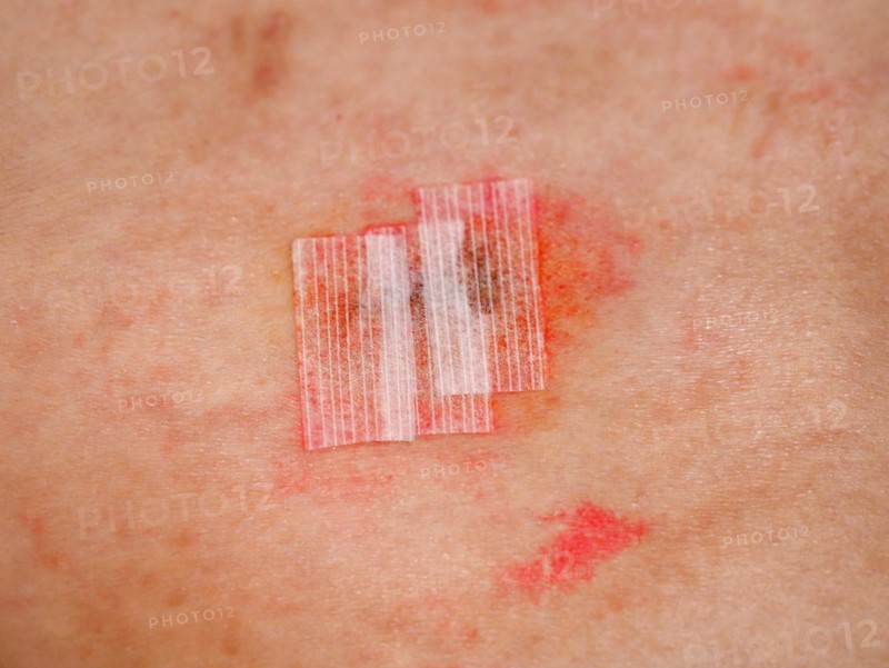 Surgical wound with steri strips and iodine tincture