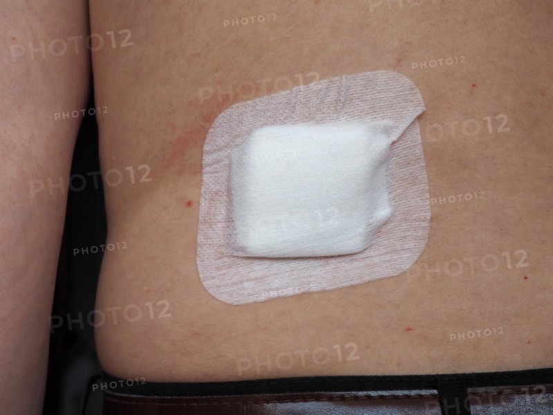 Antibacterial woundpad island dressing
