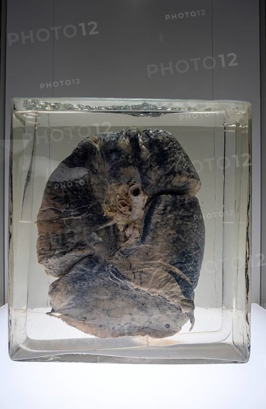 Dust lung of a miner