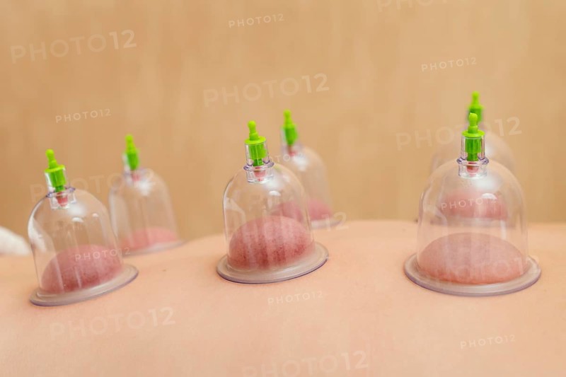 Close up patient experiencing cupping therapy