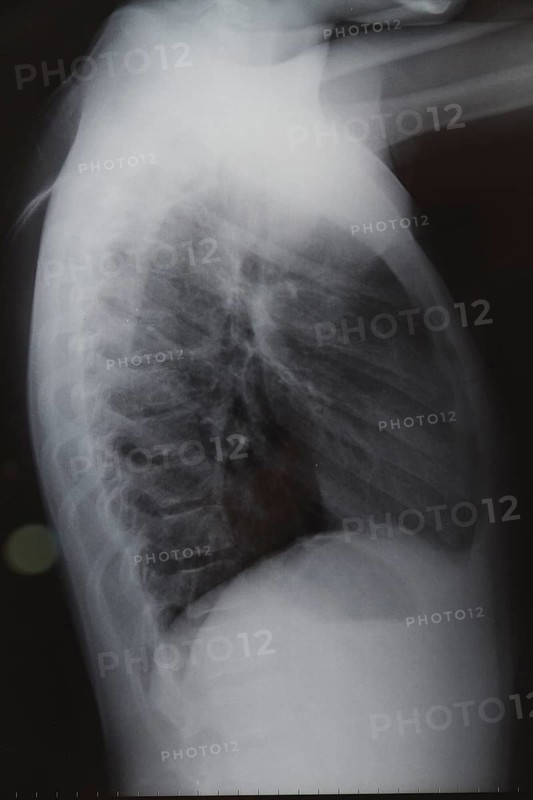X ray scan back
