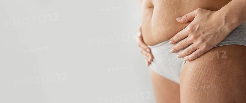 Close up body with stretch marks copy space