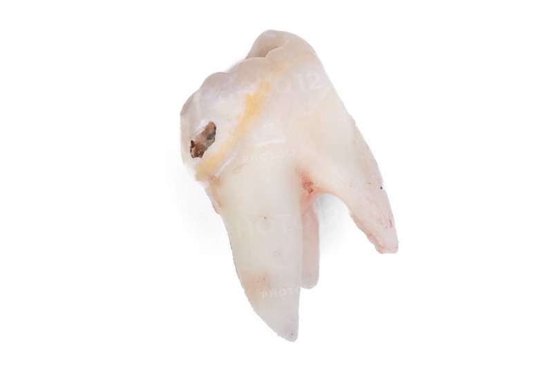 Pulled wisdom tooth