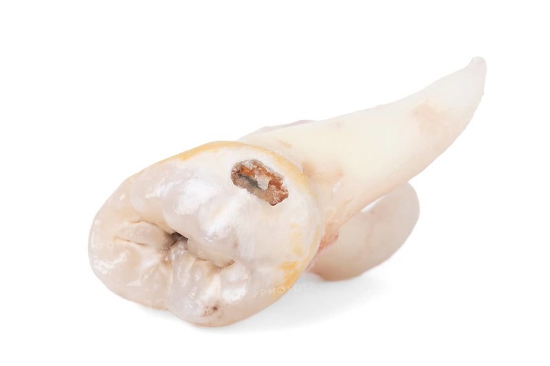 Pulled wisdom tooth