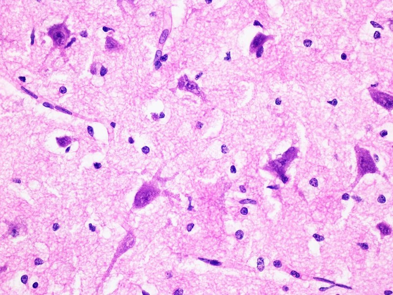 Histology of Human Brain Tissue Viewed at 400x Magnification with Haemotoxylin and Eosin Staining