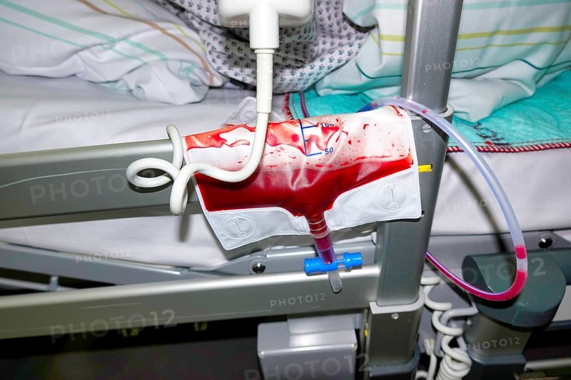 Applied wound drain slowly fills with blood and wound fluid