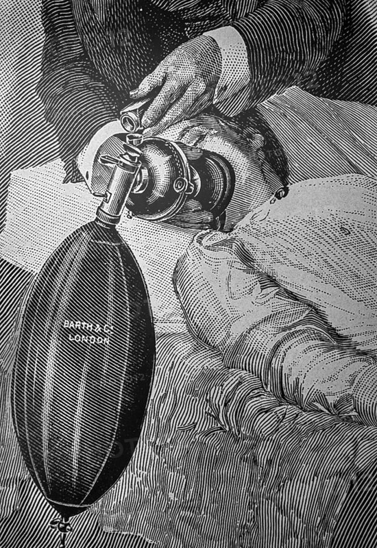 Administration of nitrous oxide and ether by means of the wide-bore modification of Clover's ether inhaler and Hewitt's nitrous oxide stopcock