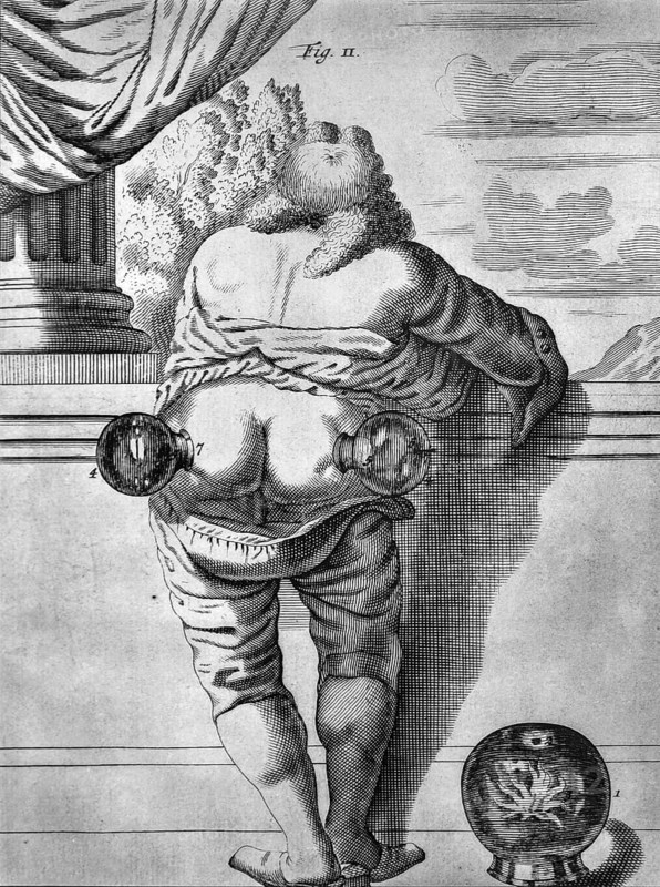 Illustration in the 1693 medical textbook Exercitationes practicae by Dutch doctor Frederick Dekkers