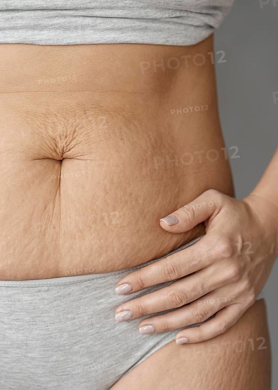 Close up body with stretch marks
