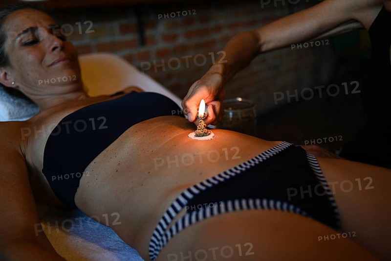Therapist apply abdominal moxibustion chinese medicine burn mugwort moxa smoking cone acupuncture point to 50s caucasian fit woman