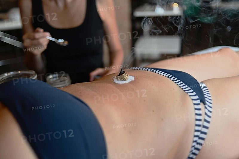 Therapist apply abdominal moxibustion chinese medicine burn mugwort moxa smoking cone acupuncture point to 50s caucasian fit woman