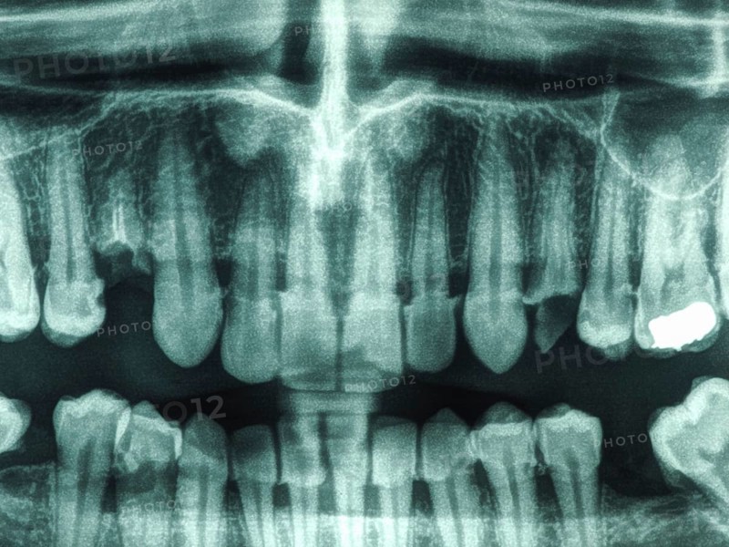 Human teeth xray