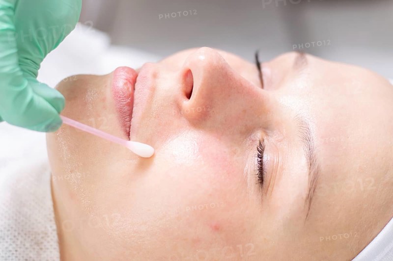 Portrait of a woman's face with problem skin. Peeling procedure. Natural beauty.