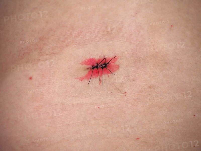 Surgical wound with stitches and iodine tincture