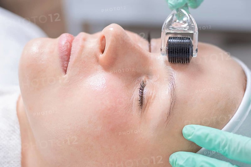Portrait of a woman's face with problem skin. Peeling procedure. Natural beauty.
