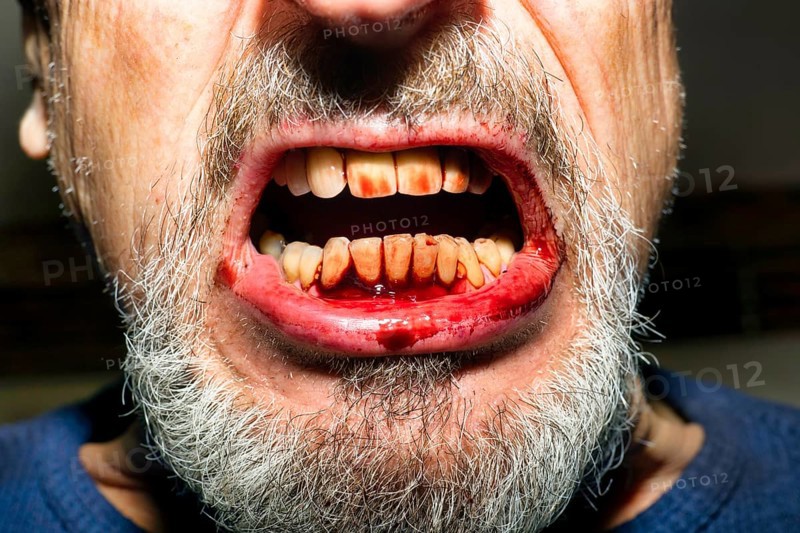 Symbol photo for aggression, Dracula, violence, brawl, injury and tantrum, an elderly man with a grey beard, bloodstained mouth, bloody gums and teeth