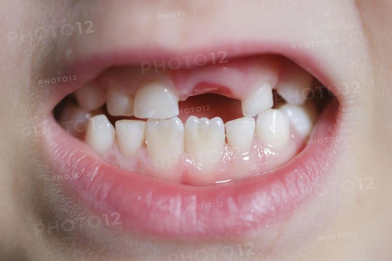 Symbolic photo on the subject of milk teeth. A six-year-old boy shows his teeth with a gap. Berlin, 07.03.2024