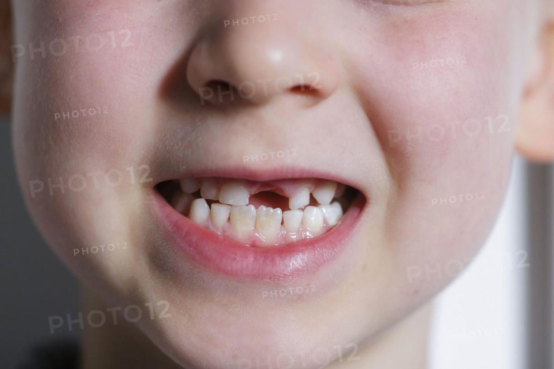Symbolic photo on the subject of milk teeth. A six-year-old boy shows his teeth with a gap. Berlin, 07.03.2024
