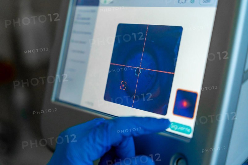 Screen used by the ophthalmologist to monitor the eye for laser application during glaucoma treatment in a patient