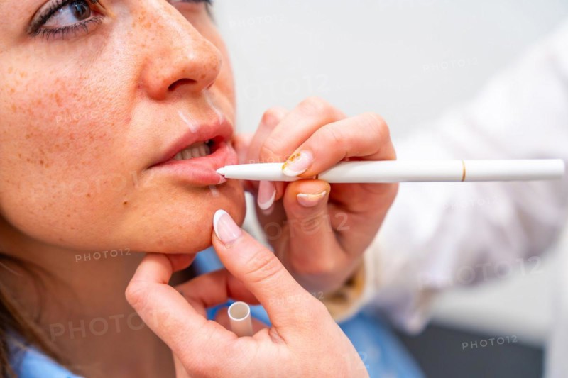 Beautician draw correction lines on woman lips to fill it with hyaluronic acid in the clinic